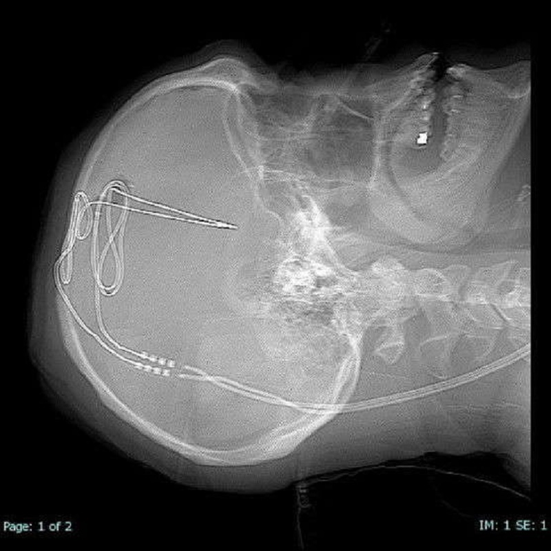 X-Ray-of-DBS-implant