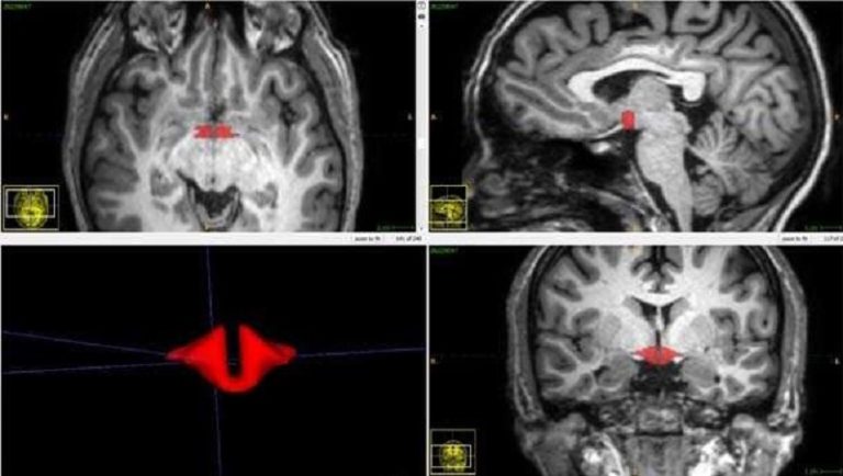 Brain Scan Depicting Hypothalamus